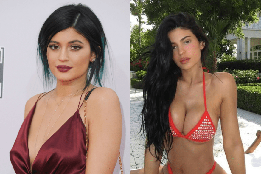 Kylie Jenner Breast Augmentation Explained