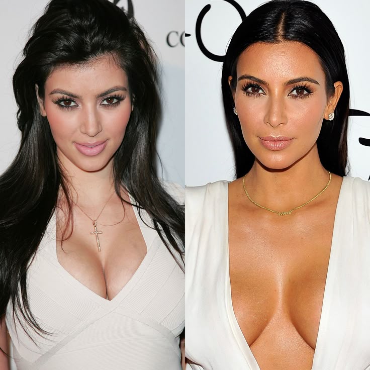 Kim Kardashian plastic surgeries revealed — from Botox to rumored body enhancements, explore her evolution and what experts believe.

