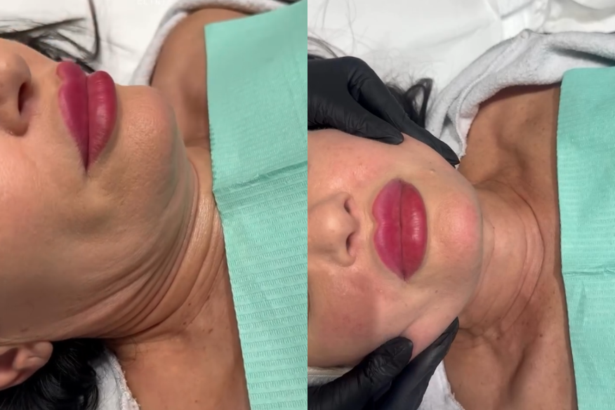 Affordable Face Lift Surgery